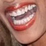 :Dentition:
