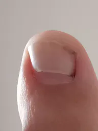 :Orteil_ongle_pied: