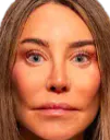 :botox3: